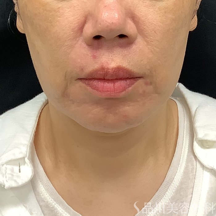症例NO.75349のBEFORE写真