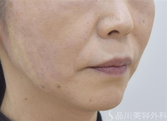 症例NO.46600のAFTER写真