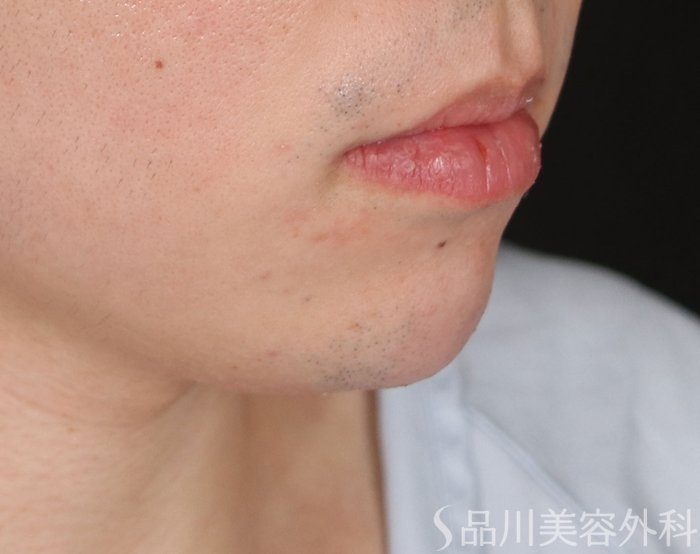 症例NO.72451のAFTER写真