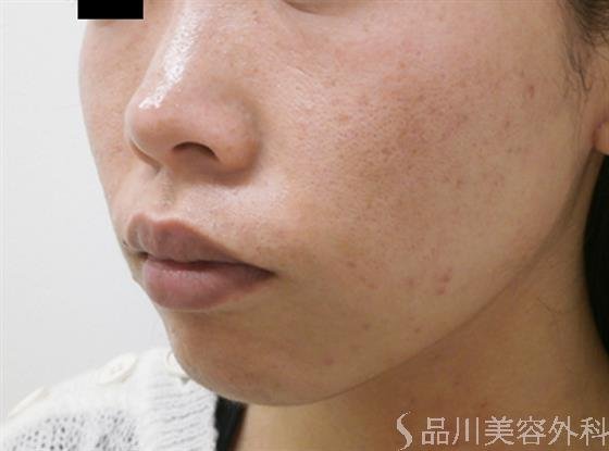 症例NO.31582のAFTER写真