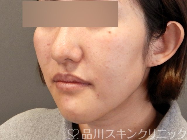 症例NO.69181のAFTER写真