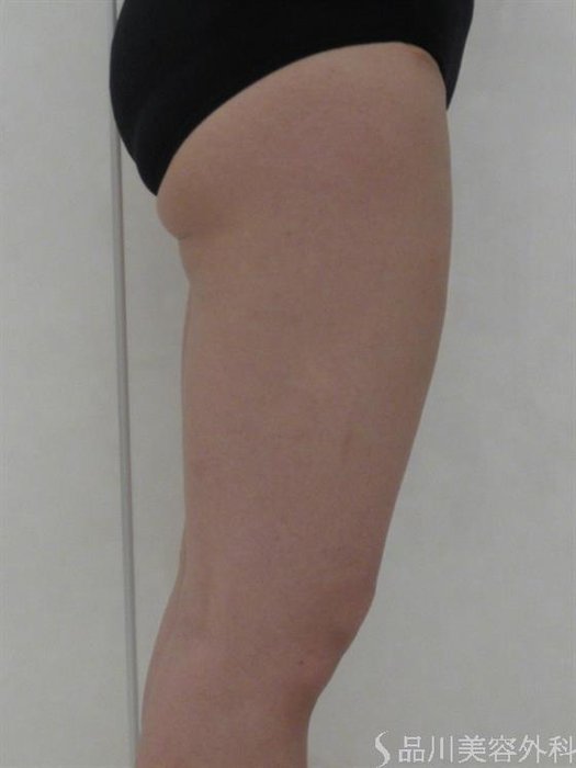 症例NO.42158のBEFORE写真