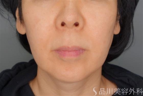 症例NO.55006のBEFORE写真