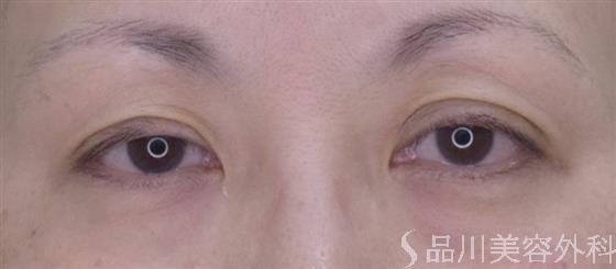 症例NO.49321のBEFORE写真