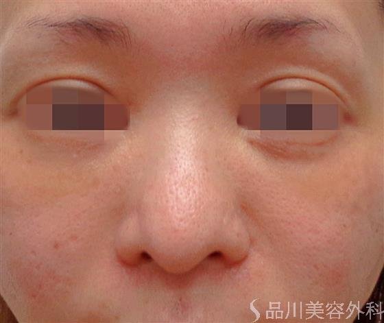 症例NO.60431のBEFORE写真