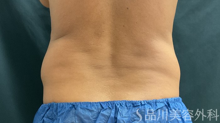 症例NO.75382のBEFORE写真