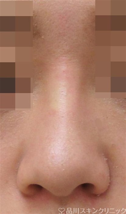 症例NO.42154のAFTER写真