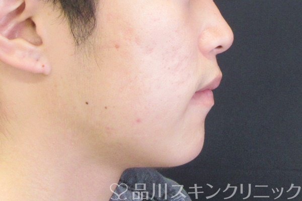 症例NO.62158のBEFORE写真