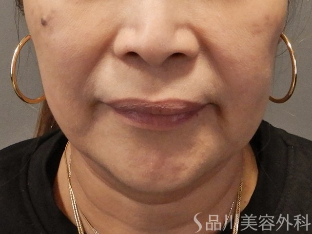 症例NO.72150のBEFORE写真