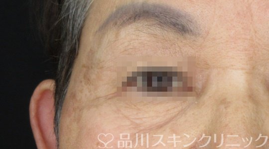 症例NO.69312のAFTER写真