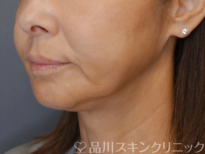 症例NO.71787のBEFORE写真