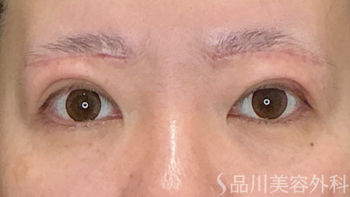 症例NO.72999のAFTER写真