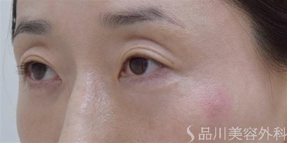 症例NO.61109のBEFORE写真