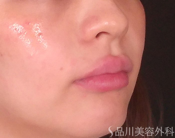 症例NO.70525のAFTER写真