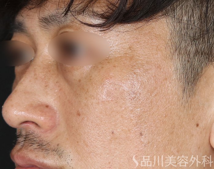 症例NO.73942のAFTER写真