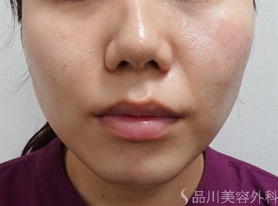 症例NO.51262のAFTER写真