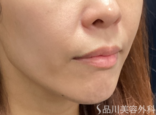 症例NO.74342のBEFORE写真