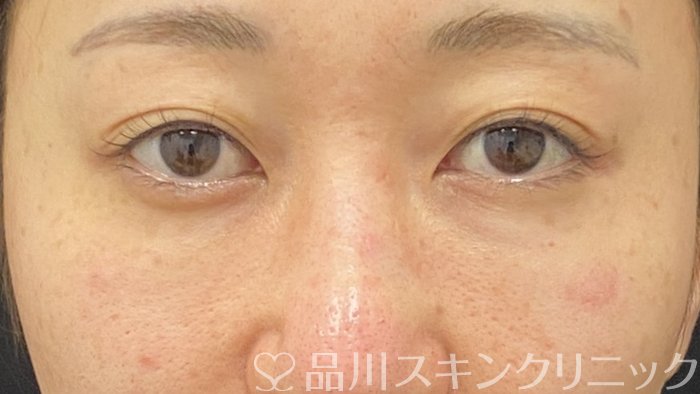 症例NO.74381のAFTER写真
