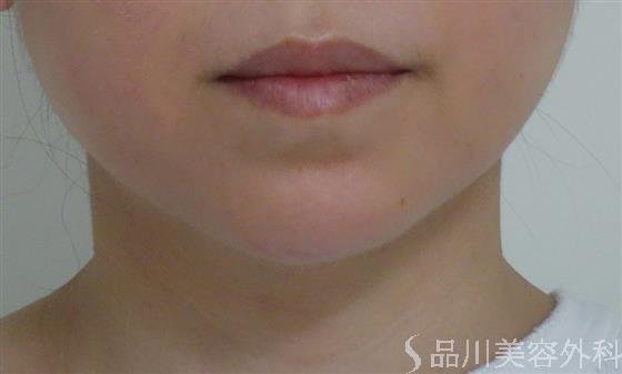 症例NO.55828のAFTER写真
