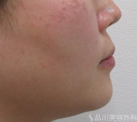 症例NO.43621のBEFORE写真