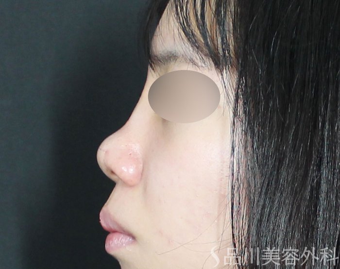 症例NO.72535のAFTER写真