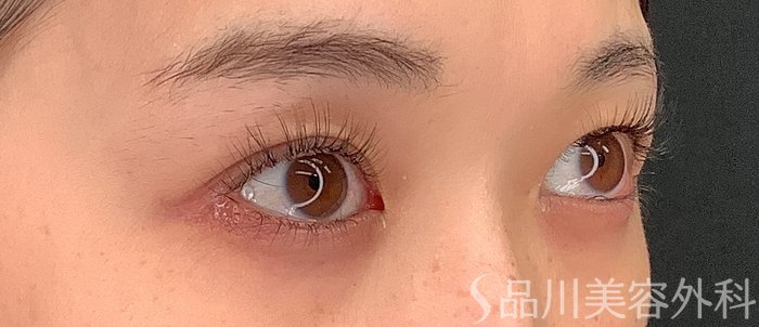 症例NO.67985のBEFORE写真
