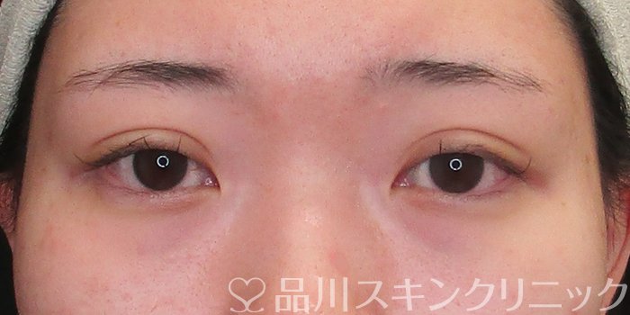 症例NO.73665のAFTER写真