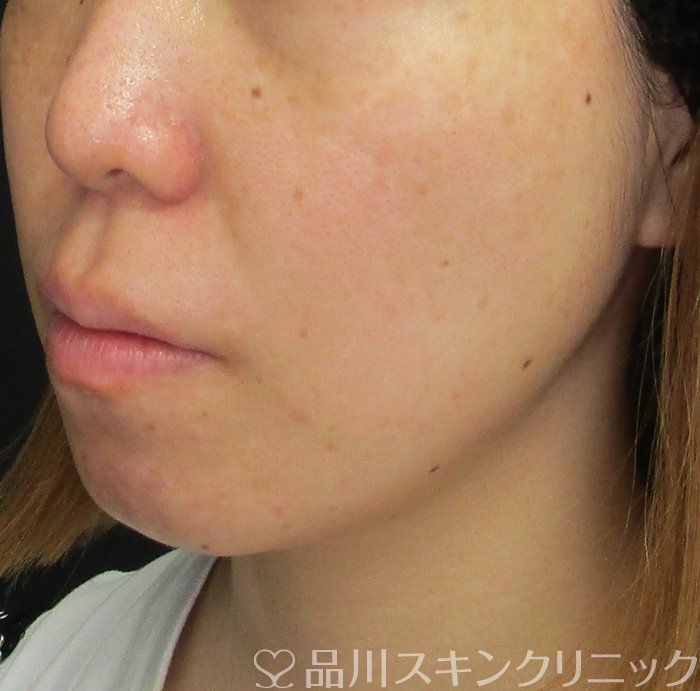 症例NO.73288のBEFORE写真