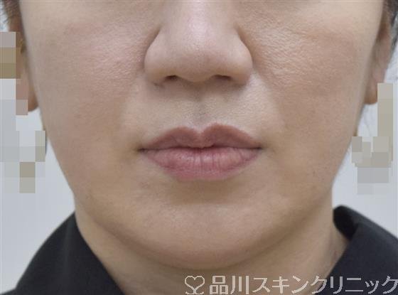 症例NO.59786のAFTER写真