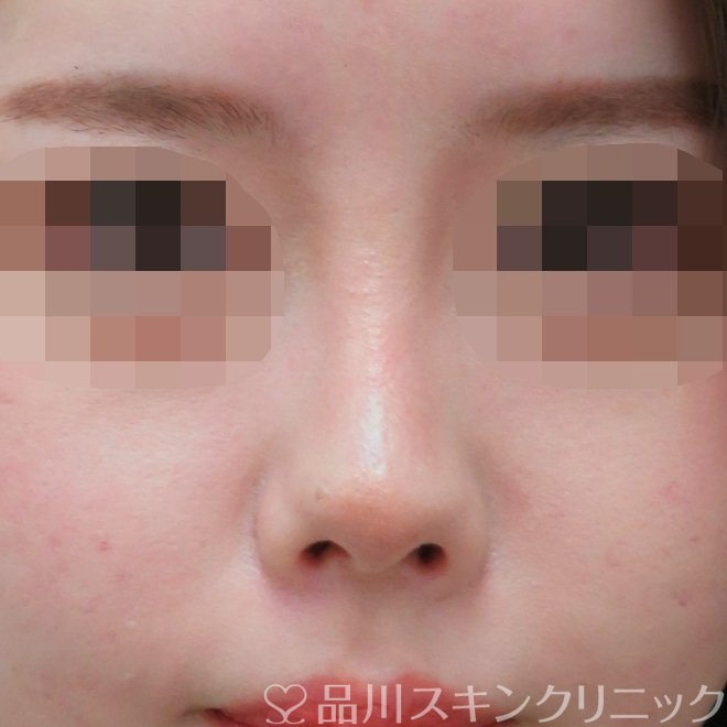 症例NO.71290のAFTER写真