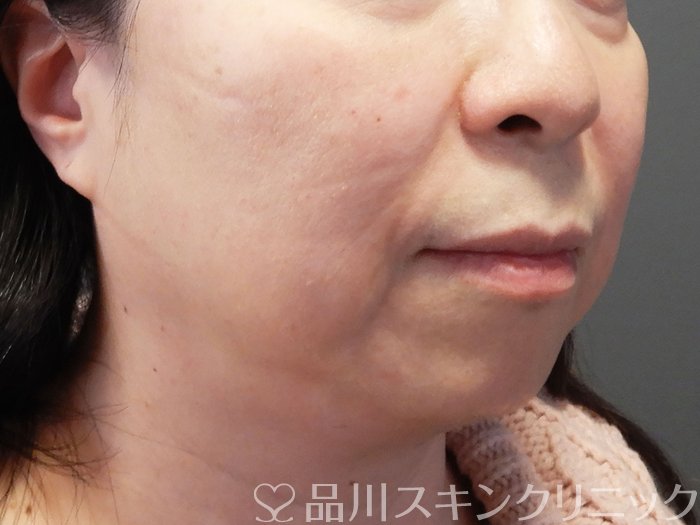 症例NO.72990のBEFORE写真