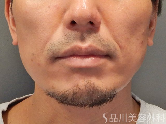 症例NO.73372のBEFORE写真