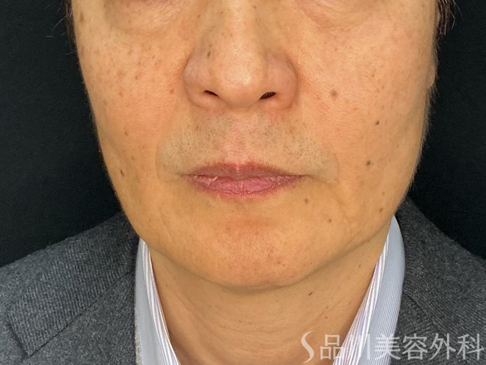 症例NO.72734のBEFORE写真