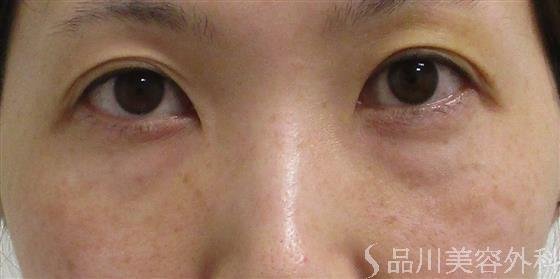症例NO.55966のBEFORE写真