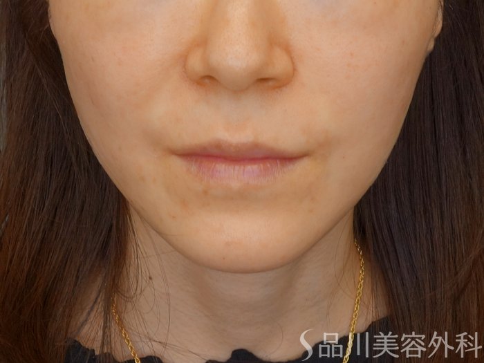 症例NO.70209のAFTER写真