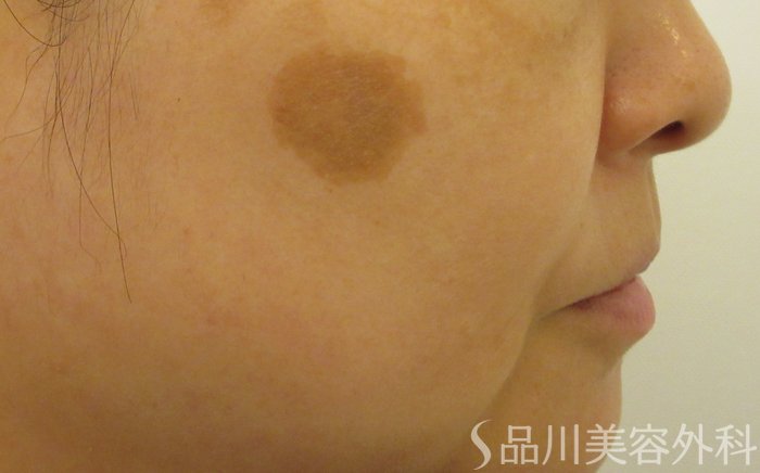 症例NO.72612のBEFORE写真