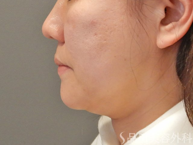症例NO.75065のBEFORE写真