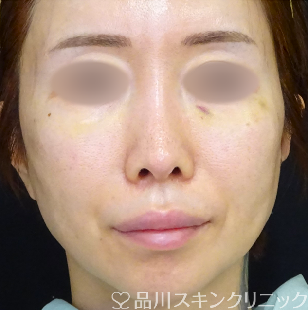 症例NO.69391のBEFORE写真