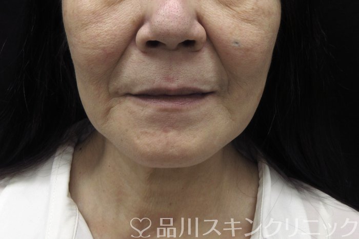症例NO.74414のBEFORE写真