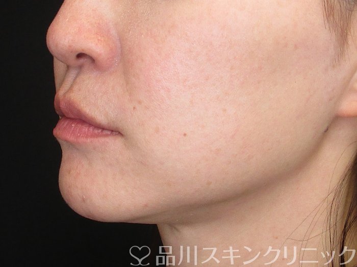 症例NO.72630のBEFORE写真