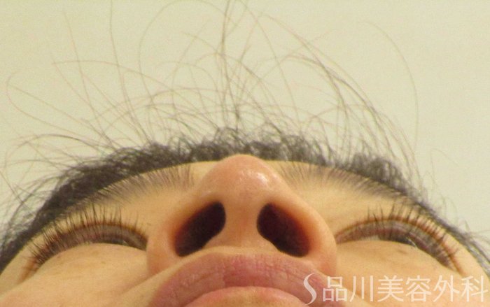 症例NO.70570のAFTER写真