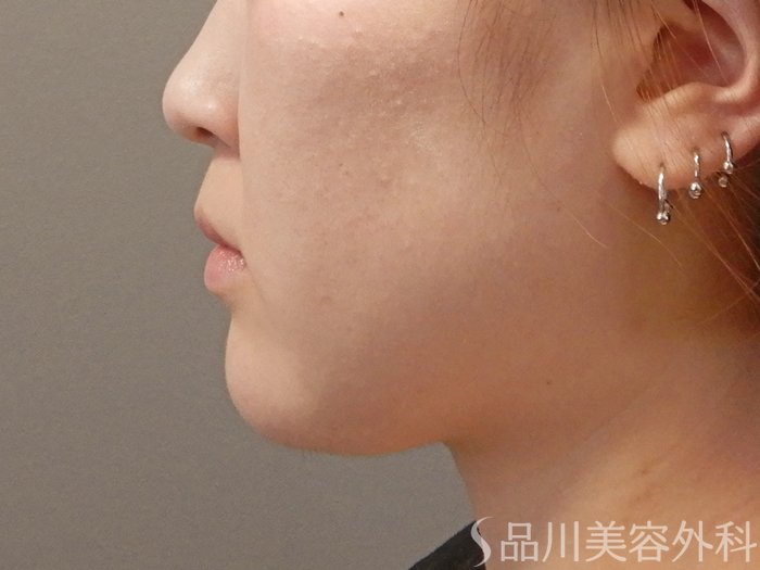 症例NO.71601のBEFORE写真