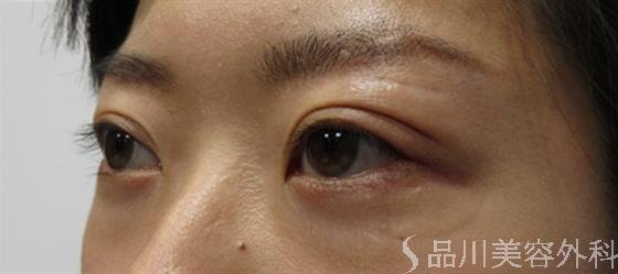 症例NO.45717のAFTER写真