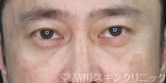 症例NO.72954のAFTER写真