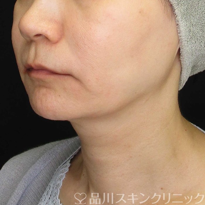 症例NO.70165のBEFORE写真