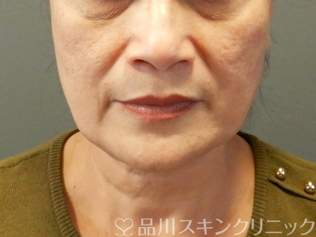 症例NO.65712のBEFORE写真