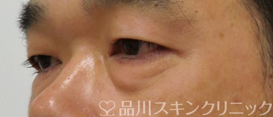 症例NO.75026のBEFORE写真