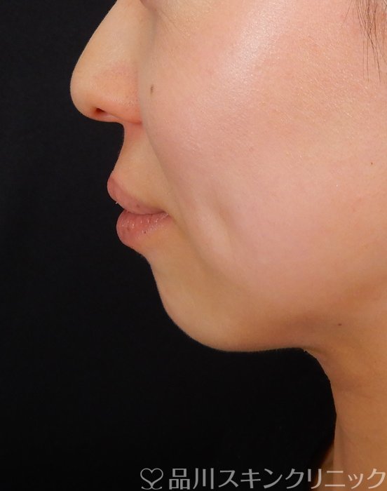 症例NO.66997のBEFORE写真