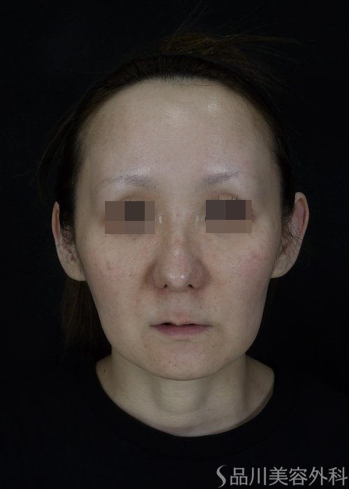 症例NO.70274のBEFORE写真