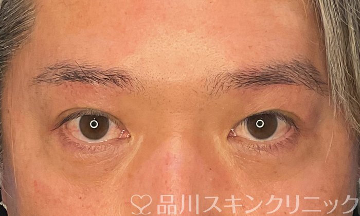 症例NO.74704のAFTER写真